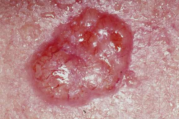 Wikimedia 98 Skin Cancer