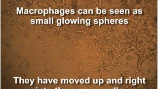 Cancer cells destroyed by First Immune GcMAF (gcmaf.eu) thumbnail